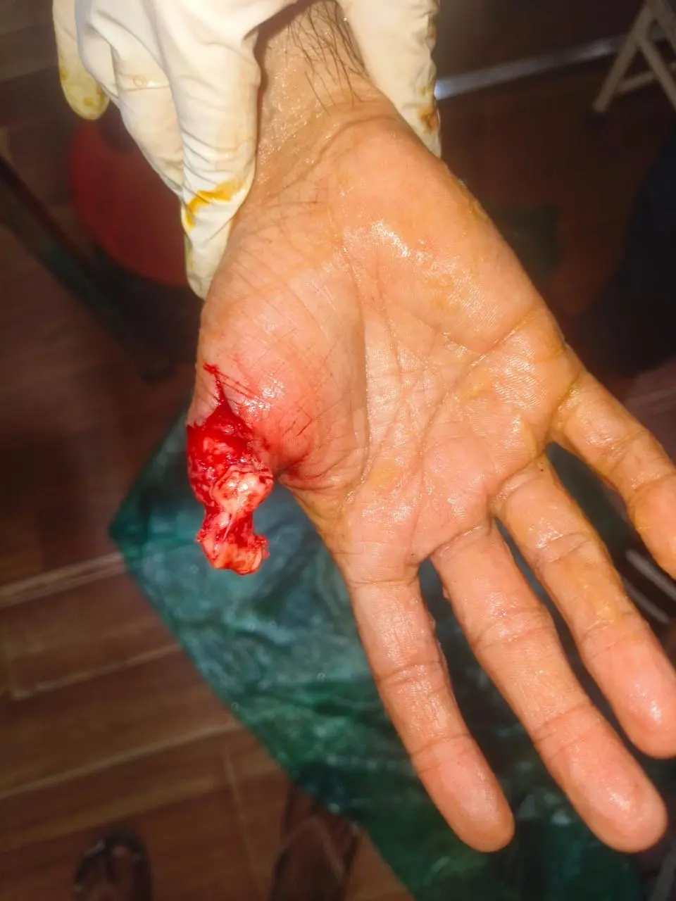 Pre-Finger Amputation - Dr Leena Jain Close-up of a hand with a deep, bleeding laceration on the palm near the thumb, exposing tissue near the wound edge.