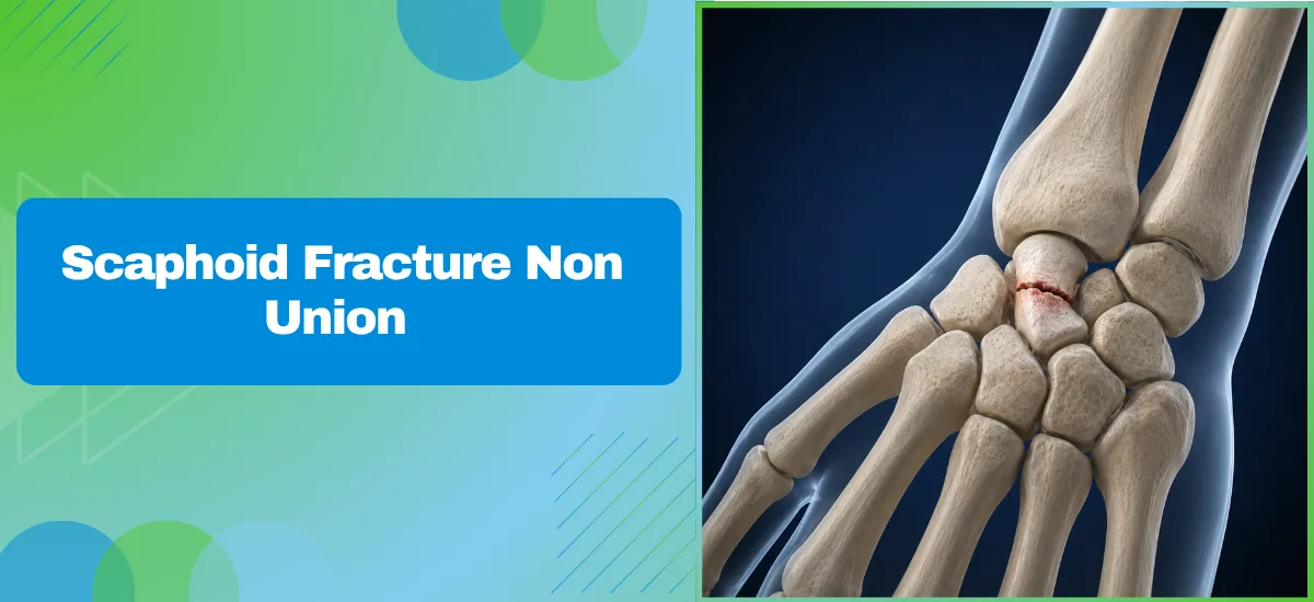 Scaphoid Fracture Non-Union