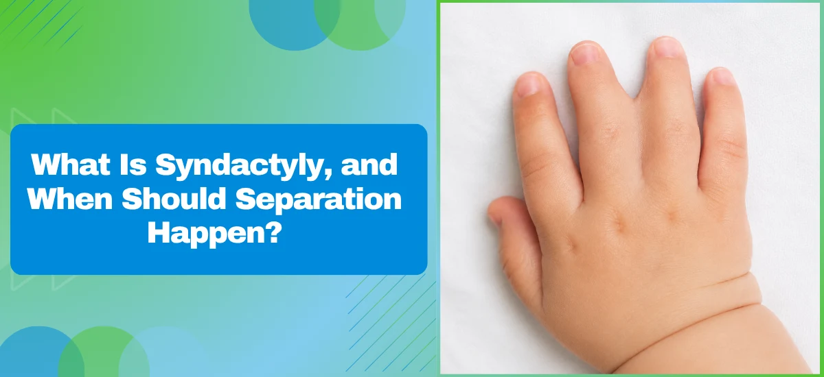 What Is Syndactyly, and When Should Separation Happen?