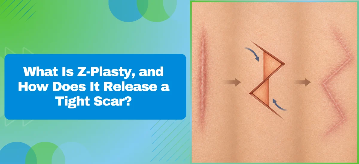 What Is Z-Plasty and How Does It Release a Tight Scar