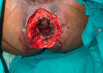 Postoperative open wound on the buttock with exposed tissue, surrounded by teal surgical drapes/scrubs.