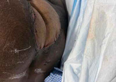 Close-up of a dark-skinned arm with a circular stitched surgical wound, covered by a blue medical drape.