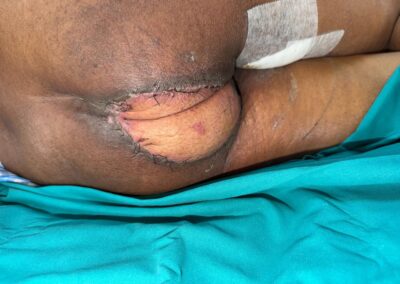 Postoperative buttock wound with sutures and a taped dressing, lying on a teal surgical drape.