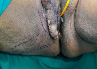 Surgical scene: sterile drapes reveal a male patient's genital region with marked lines and a yellow catheter tube, during an operation.