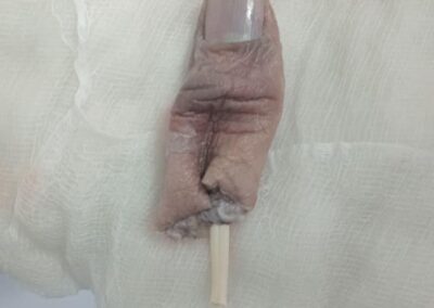 Close-up of a gloved hand with an injured fingertip, a small wooden splint protruding from the end, wrapped in gauze.