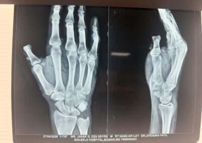 Two-view X-ray of hands: AP view of left hand and lateral view of right hand, showing carpals, metacarpals, and phalanges.