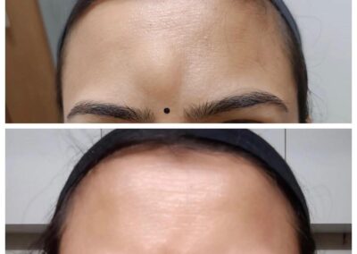 Before and after shots of a woman's forehead showing reduced frown lines after treatment; top image shows minor lines, bottom is smooth and wrinkle-free.