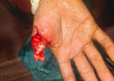 Open palm with a deep, jagged wound on the base of the thumb area and exposed tissue; bleeding evident, gloved hand nearby suggesting a medical context.