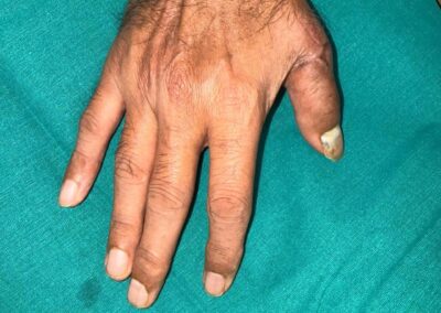 Hand with a partially amputated right thumb resting on teal surgical drape, showing a stump and visible nail.