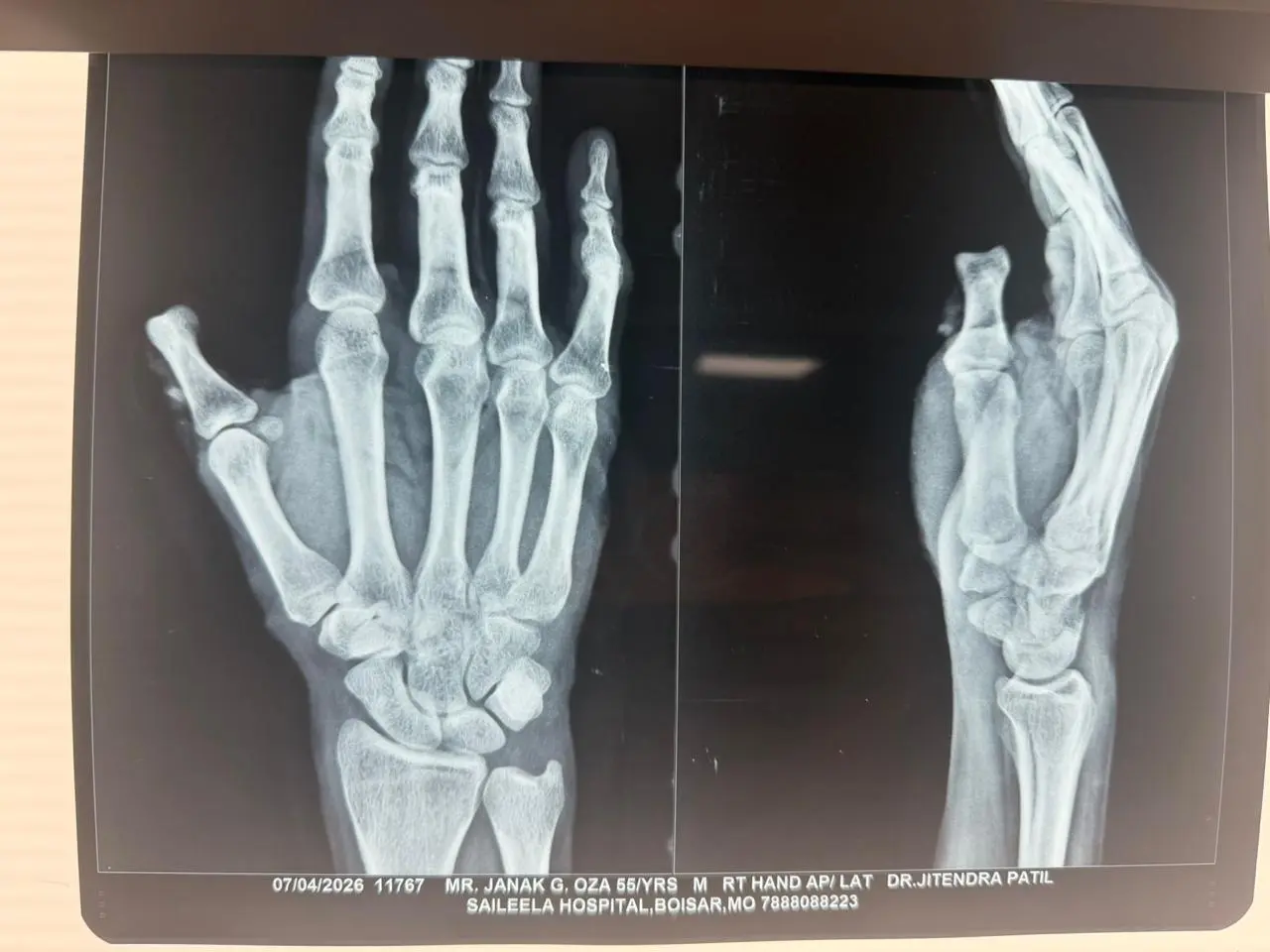 X-ray of a left hand and a right foot, showing the bones (phalanges, metacarpals, and tarsals) for medical assessment.