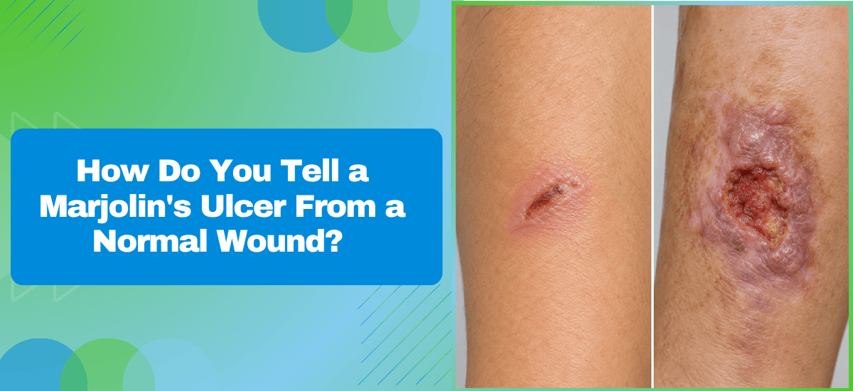 How Do You Tell a Marjolin’s Ulcer From a Normal Wound?