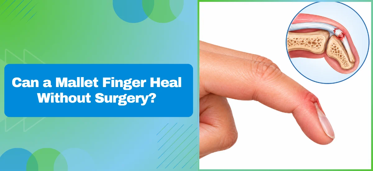 Can a Mallet Finger Heal Without Surgery
