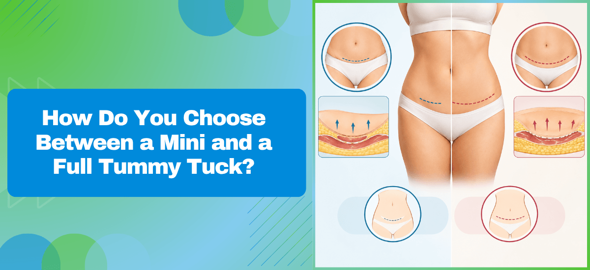 How Do You Choose Between a Mini and a Full Tummy Tuck