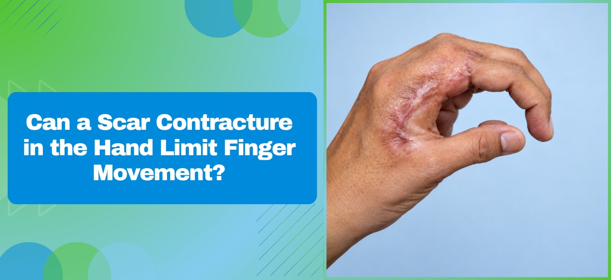 Can a Scar Contracture in the Hand Limit Finger Movement?