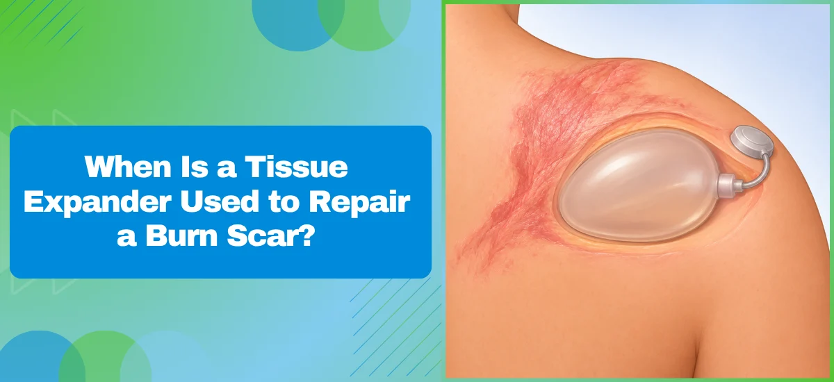 When Is a Tissue Expander Used to Repair a Burn Scar?